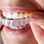 How Much Does Invisalign Cost in Taunton
