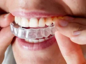 How Much Does Invisalign Cost in Taunton