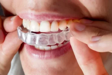 How Much Does Invisalign Cost in Taunton